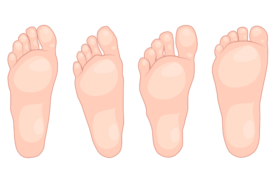 Typy chodidel - tvar chodidla 2